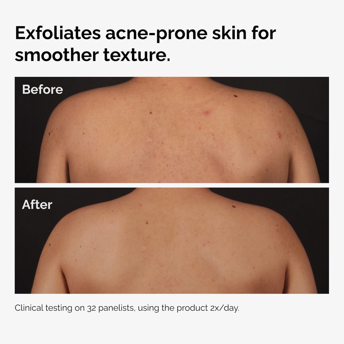 salicylic-acid-0-5-body-serum-f7 ord-salicylic-acid-body-serum-before-after-graphic-NA.jpg