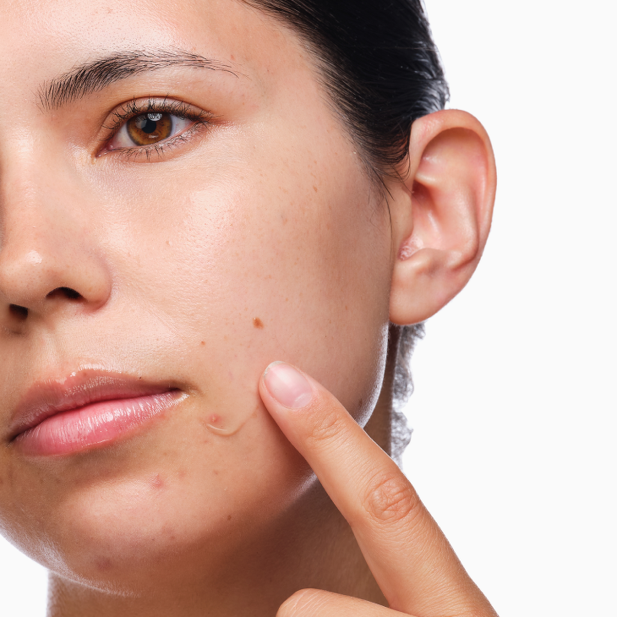 the-acne-set-s5 rdn-the-acne-set-application.png